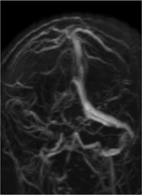 Mrv Revealed Thrombosis In The Right Transverse And Sigmoid Sinuses