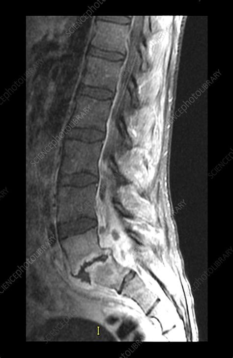 Epidural Abscess Mri Stock Image C027 1899 Science Photo Library