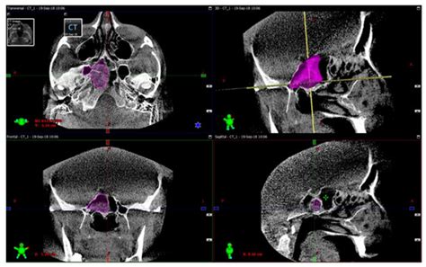 Diagnostics Free Full Text Intraoperative Sphenoid Sinus Volume