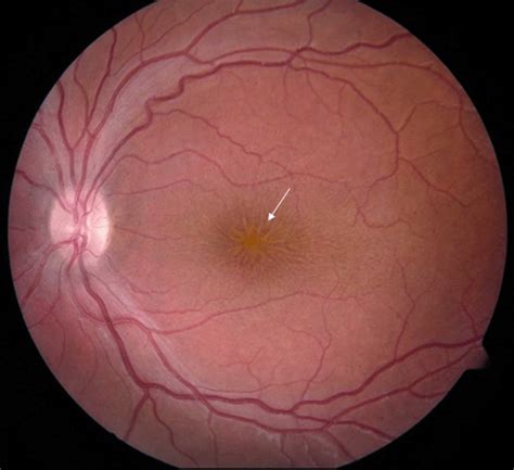 Retinoschisis causes, symptoms, diagnosis & retinoschisis treatment