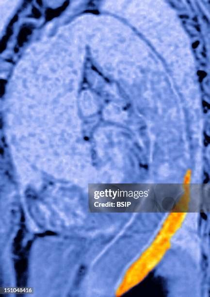 14 Thoracic Aorta Dissection Stock Photos, High-Res Pictures, and Images - Getty Images