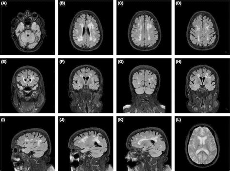 Brain Mri Findings Of The Proband The Flair Images Ak Demonstrated