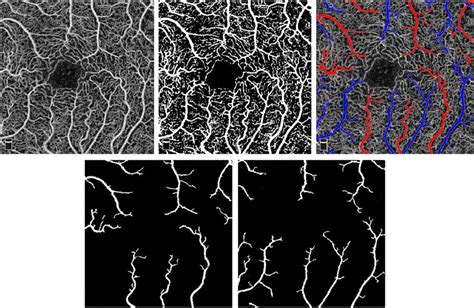 Upper left Raw fovea centered 3 Â 3 mm OCT angiography OCTA of the