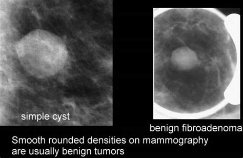 Basic Information About Mammograms