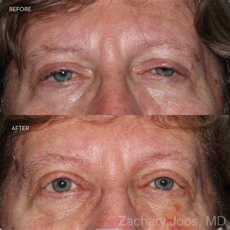 Ptosis Repair Before And After Photos Kirkland Bellevue Marina Park