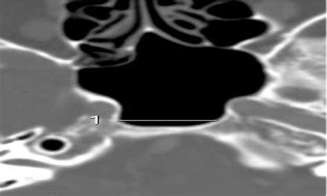 Figure 1 From Anatomical Variations Of Sphenoid Sinus On Multi Detector