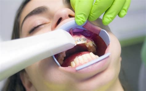 Para qué sirve un escáner intraoral Abaden Dentistas