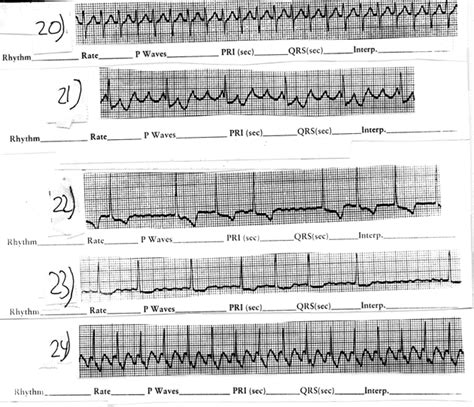 Ekg Worksheets