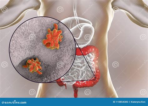 Entamoeba Histolytica Protozoan Infection Of Large Intestine Stock Illustration Illustration