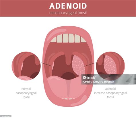 Nasal And Throat Nasopharynx Diseases Adenoids Diagnosis And Treatment