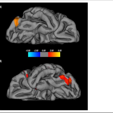 Voxel Based Morphometry Gray Matter Volume Enlargements While Viewing