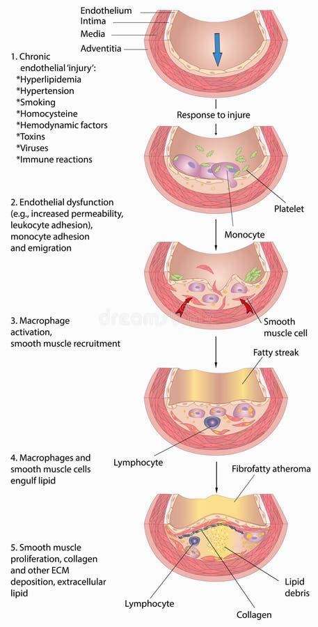 Pathogenesis Of Atherosclerotic Plaque In Blood Vessels Stock Vector