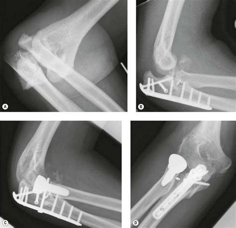 Monteggia Fracture Pictures Symptoms Causes Diagnosis