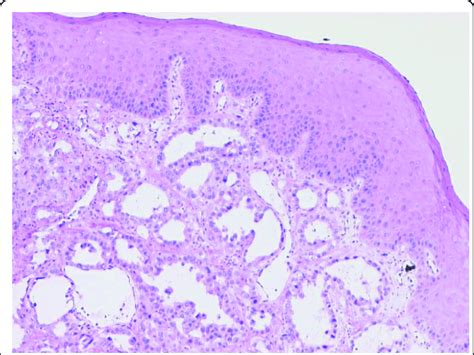 Conventional H&E morphology (50× and 100×) showing squamous mucosa with ...