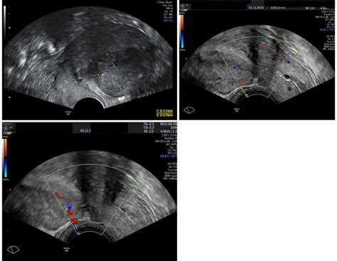 Ultrasound showing inward retraction niche in anteverted flexed (AVF ...