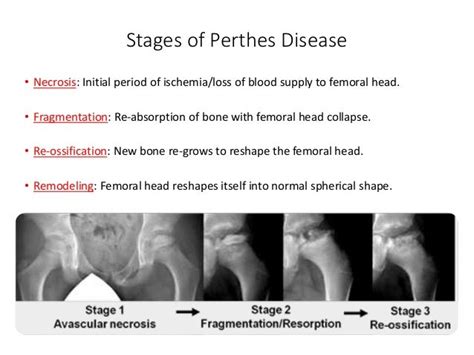 Perthes Disease Stages