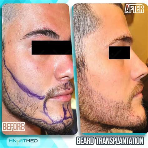 Beard Transplant In Turkey Best Scarless Results And 2024 Price