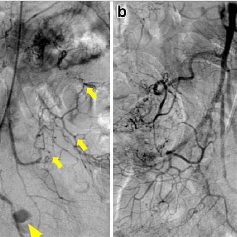 Coil Embolization Of A Ruptured Pseudoaneurysm Of Angiographic