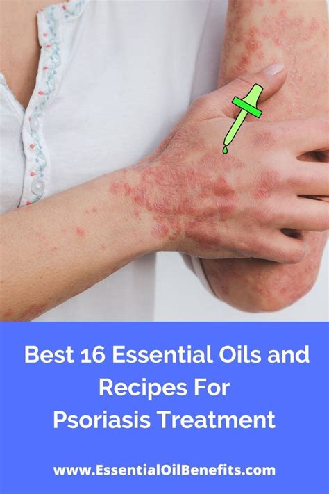 Eczema Psoriasis Remedies Abound Symptoms Artofit