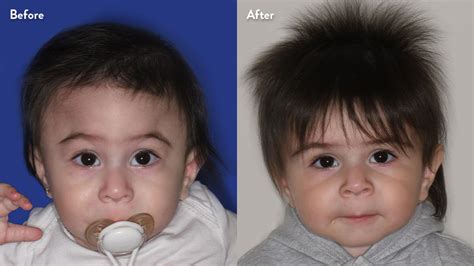 Craniosynostosis Before and After Photos - Stanford Medicine Children's ...