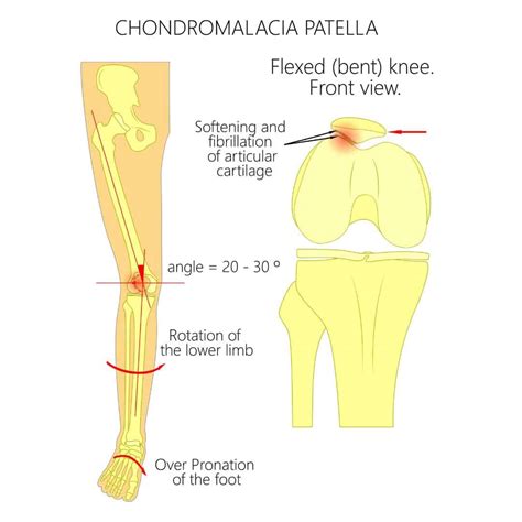 Chondromalacia Patella Treatment | Braces & Taping | Surgery