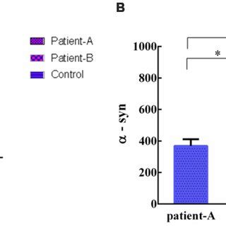 The levels of serum α syn of Patient A was significantly different with