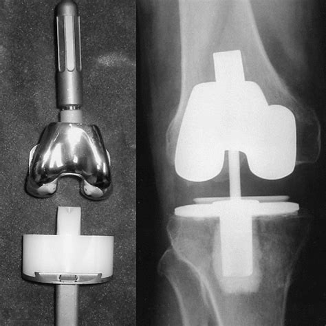 Pdf Stemless Constrained Total Knee Arthroplasty An Obsolete Concept