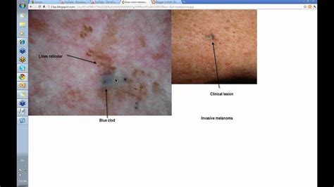 Dermoscopy Made Simple Melanoma Youtube