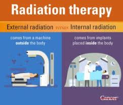 Radiation Therapy Best Expert Writers