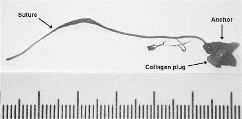 Remnant Of Angio Seal Extracted From The Right Anterior Tibial Artery