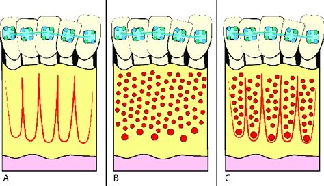 A Corticotomies B Mops C Combination Of Both Techniques