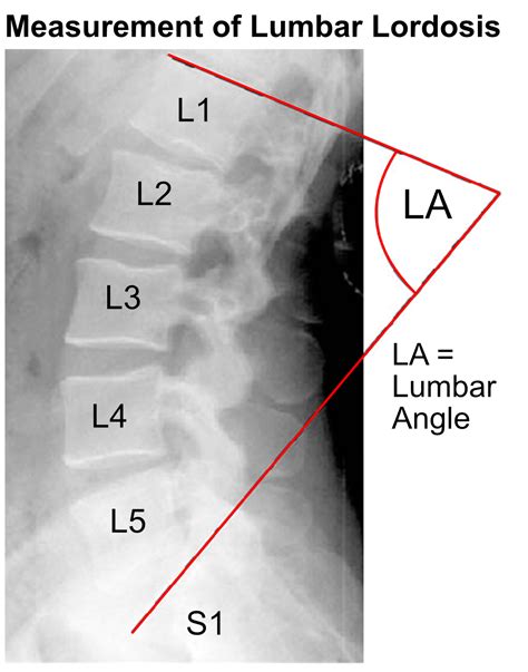 Lumbar Lordosis Or Hyperlordosis Back Care Clinic