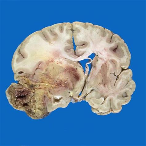 Glioblastoma IDH Wildtype Radiology Reference Article Radiopaedia Org