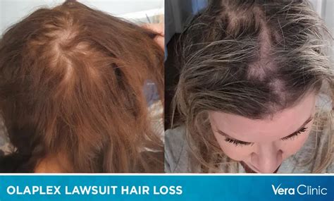 Olaplex Lawsuit Hair Loss: Significance & Lawsuit Details