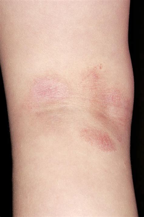 Atopic Eczema Photograph By Dr P Marazzi Science Photo Library