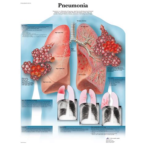 3b Scientific Pneumonia Chart