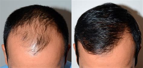 How Much Do Hair Transplants Cost? | Hair Transplant Cost Guide