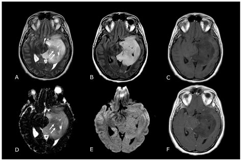 Biomedicines Free Full Text Magnetic Resonance Imaging Of Primary Adult Brain Tumors State