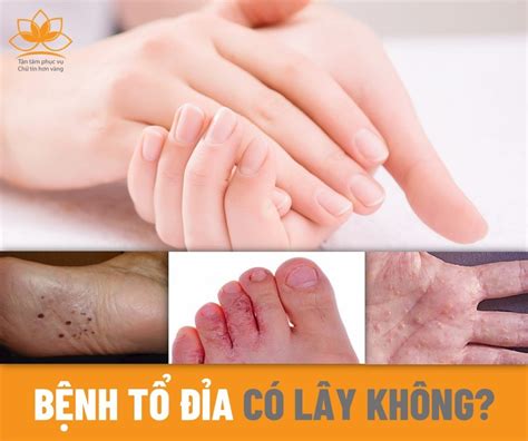 BỆNH TỔ ĐỈA CÓ LÂY KHÔNG? | Công ty TNHH Dược Mỹ Phẩm Sen Vàng