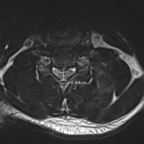 Preoperative MRI (STIR sequence sagittal (Figure 1a) and T2 axial ...