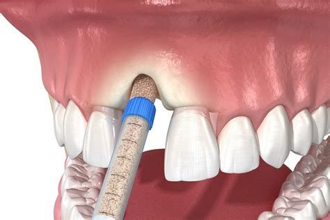 What Is Dental Bone Grafting What To Expect