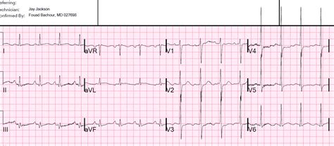 Dr Smiths Ecg Blog Ischemic St Depression Maximal In V1 V4 Vs V5