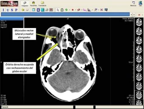 Celulitis Orbitaria Presentaci N De Un Caso Gonz Lez Garc A