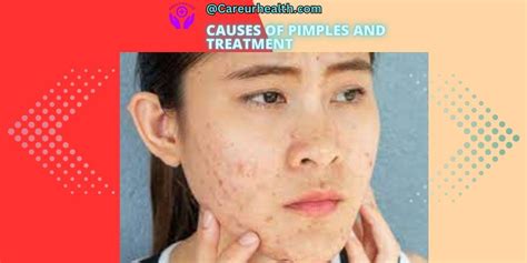 Causes of pimples | Acne and treatment - Care ur Health