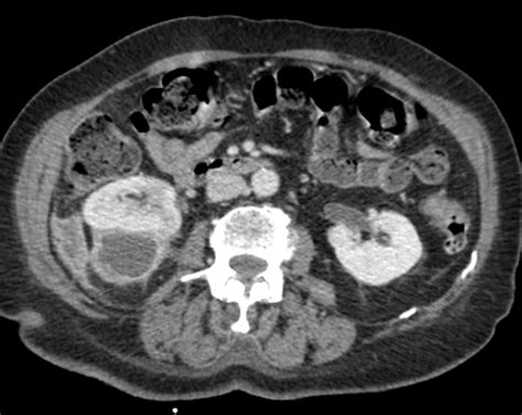 Percutaneous Renal Abscess Drainage