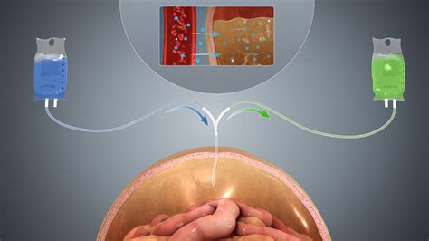 Kidney issue: Peritoneal dialysis procedure | Urinary Tract Issues ...