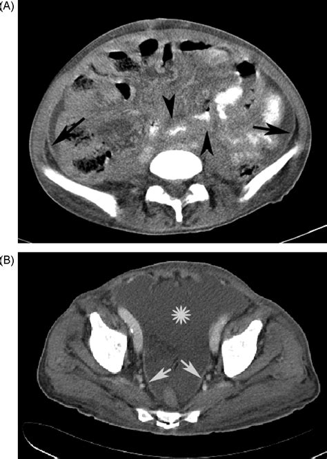 Ct Findings Of Lymphoma With Peritoneal Omental And Mesenteric