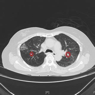 PDF Lung Cancer Detection System Using Image Processing And Machine