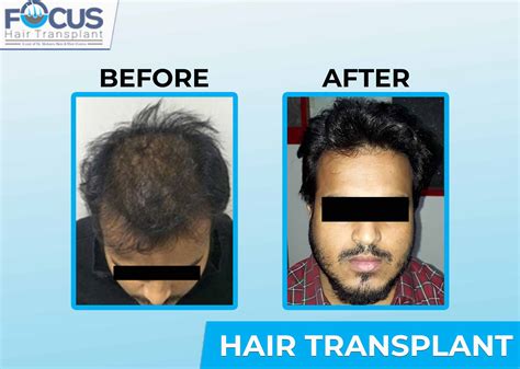 Hair Transplant In Punjab India Hair Transplant Centre In Jalandhar