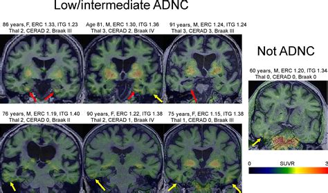 Flortaucipir Pet Uncovers Relationships Between Tau And Amyloid β In